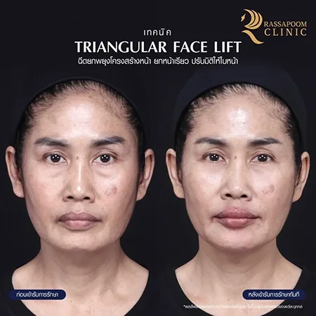 Triangular Face Lift